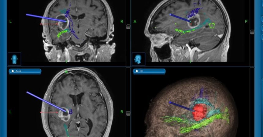 Caltanissetta, intervento neurochirurgico con l’aiuto della trattografia