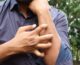 Studio Novartis, l’orticaria cronica spontanea costa 4.200 euro l’anno a paziente